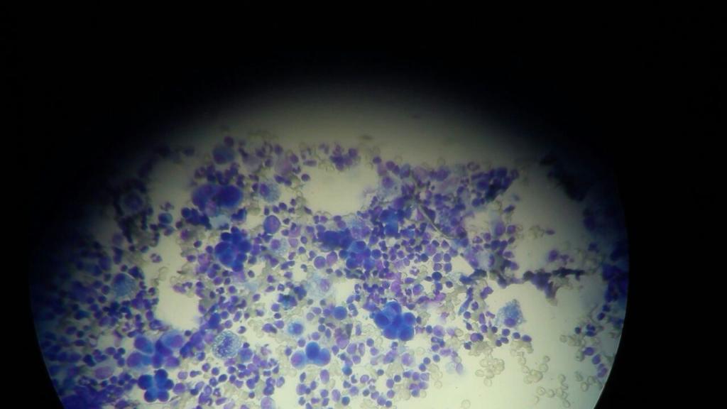 Imagen microscópica de una citología realizada por aspiración con aguja fina: El diagnóstico es de carcinoma mamario 